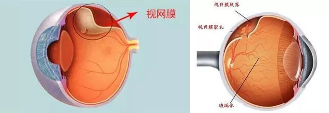 3.开角型青光眼