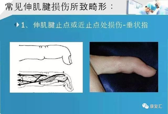 康复基础手部肌腱解剖及功能