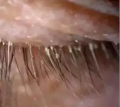 毛囊蠕形螨喜欢藏在睫毛根部,感染的患者常常会有掉睫毛,睫毛鳞屑等