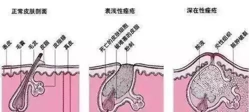 微粉刺怎么办