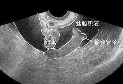 怀孕了盆腔积液怎么办