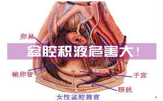 怀孕了盆腔积液怎么办