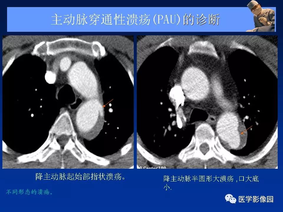 主动脉夹层壁间血肿及穿通性溃疡的影像诊断与鉴别诊断影像天地