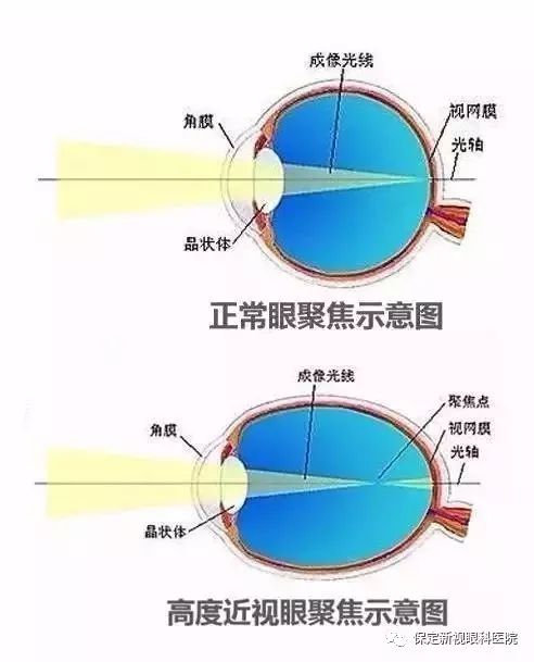 通过手术摘掉眼镜,是高度近视的一种矫正办法.