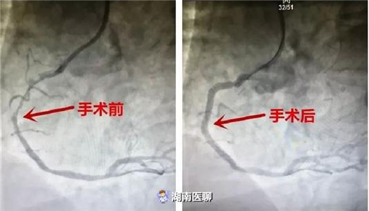 无症状心肌缺血(隐匿性冠心病)