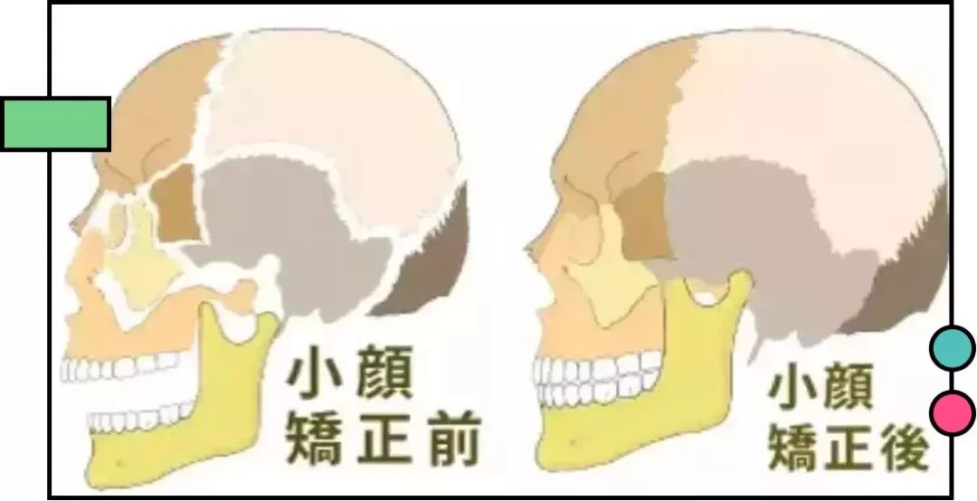 会导致人的 颅骨缝变大或骨错位