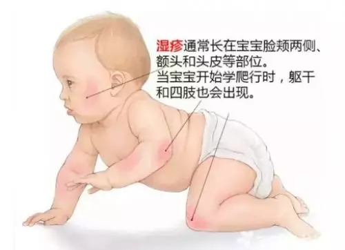 小孩湿疹了怎么办