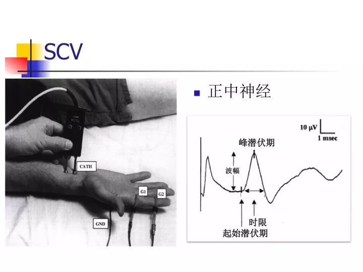 肌电图常识和应用基础