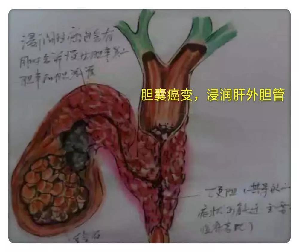 【图解】胆囊结石不治疗 ,竟有这种「危害 」.