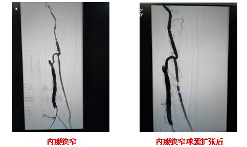 续航尿毒症患者生命线福医二院外周血管通路术成效显著