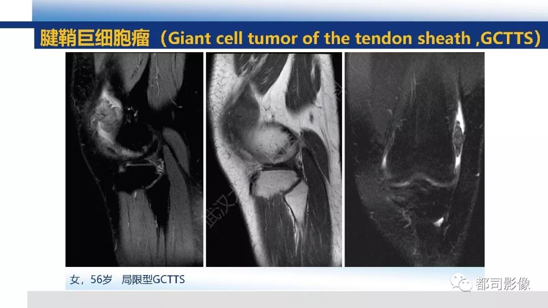 腱鞘巨细胞瘤影像诊断及鉴别