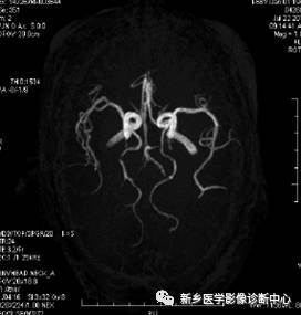 双侧胚胎型大脑后动脉基底动脉型大脑后动脉18,右侧椎动脉开窗畸形19