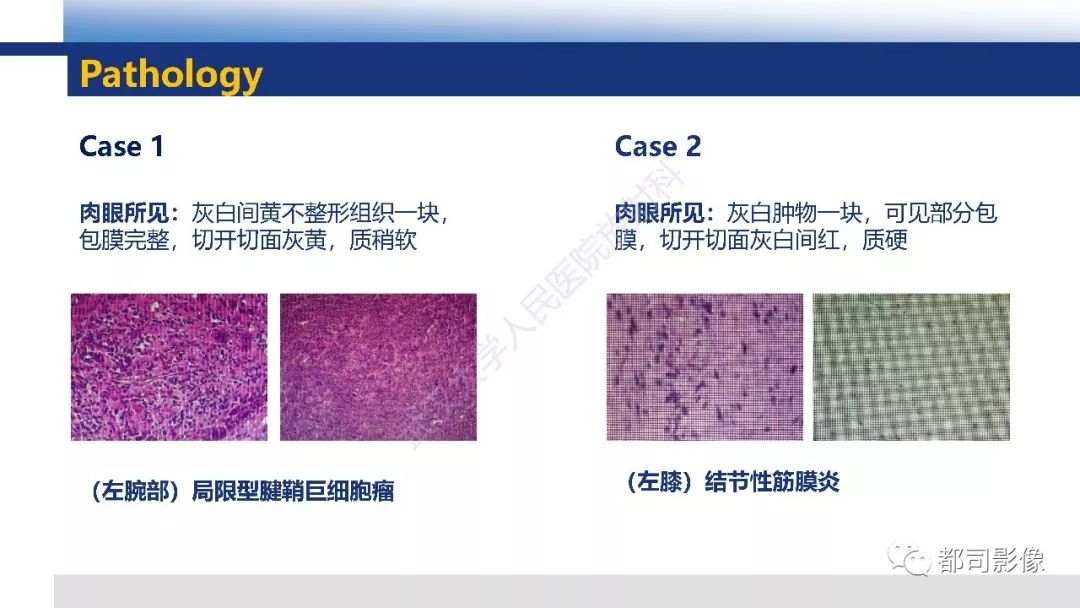 腱鞘巨细胞瘤影像诊断及鉴别