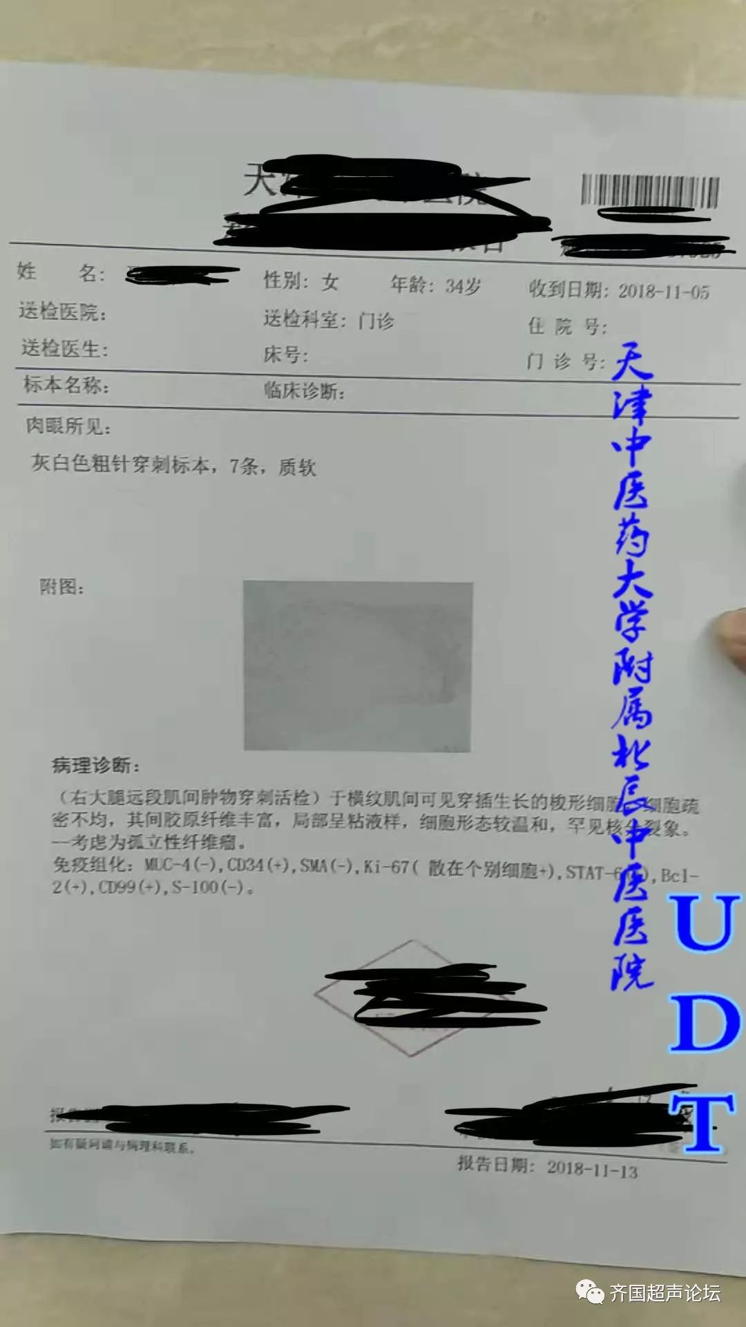 (大腿)考虑孤立性纤维瘤--udt(病例537)