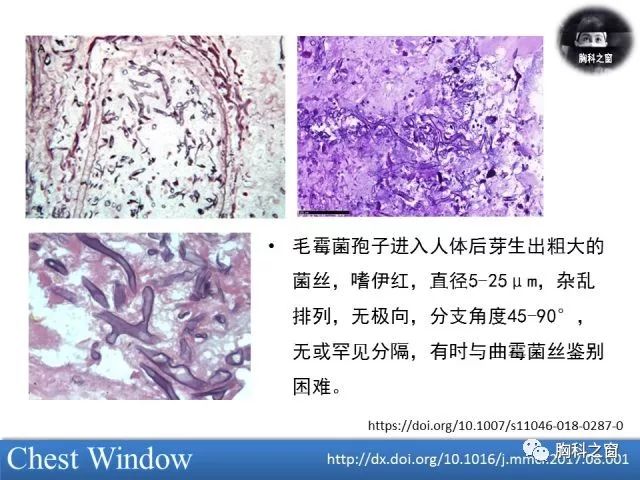 肺毛霉病的影像学表现