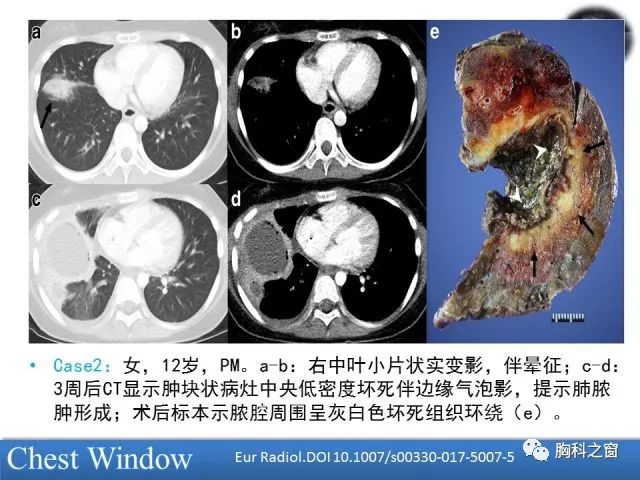 肺毛霉病的影像学表现
