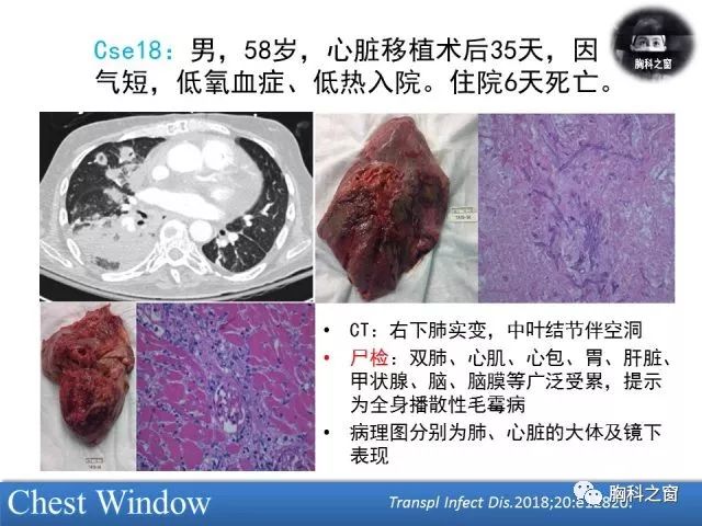 肺组织侵犯,肺凝固性坏死;血管侵犯致肺出血,血栓形成,出血性肺梗死和