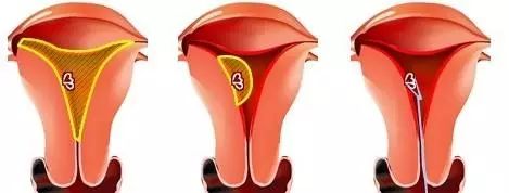 各种宫腔手术如人工流产,放环取环手术造成子宫内膜损伤,宫腔粘连,是