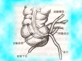 阑尾炎反复发作怎么办