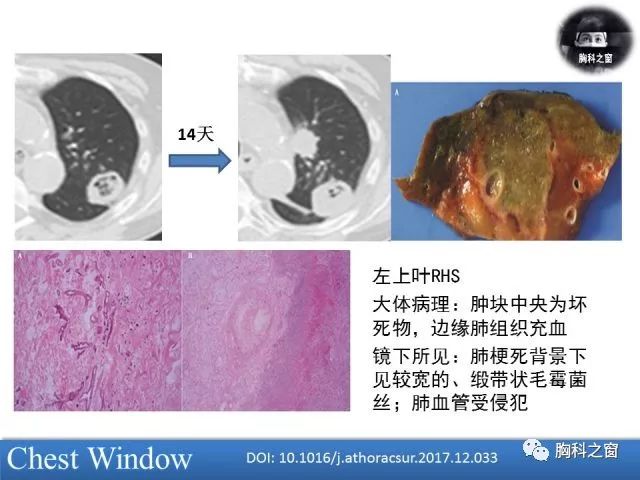 肺毛霉病的影像学表现