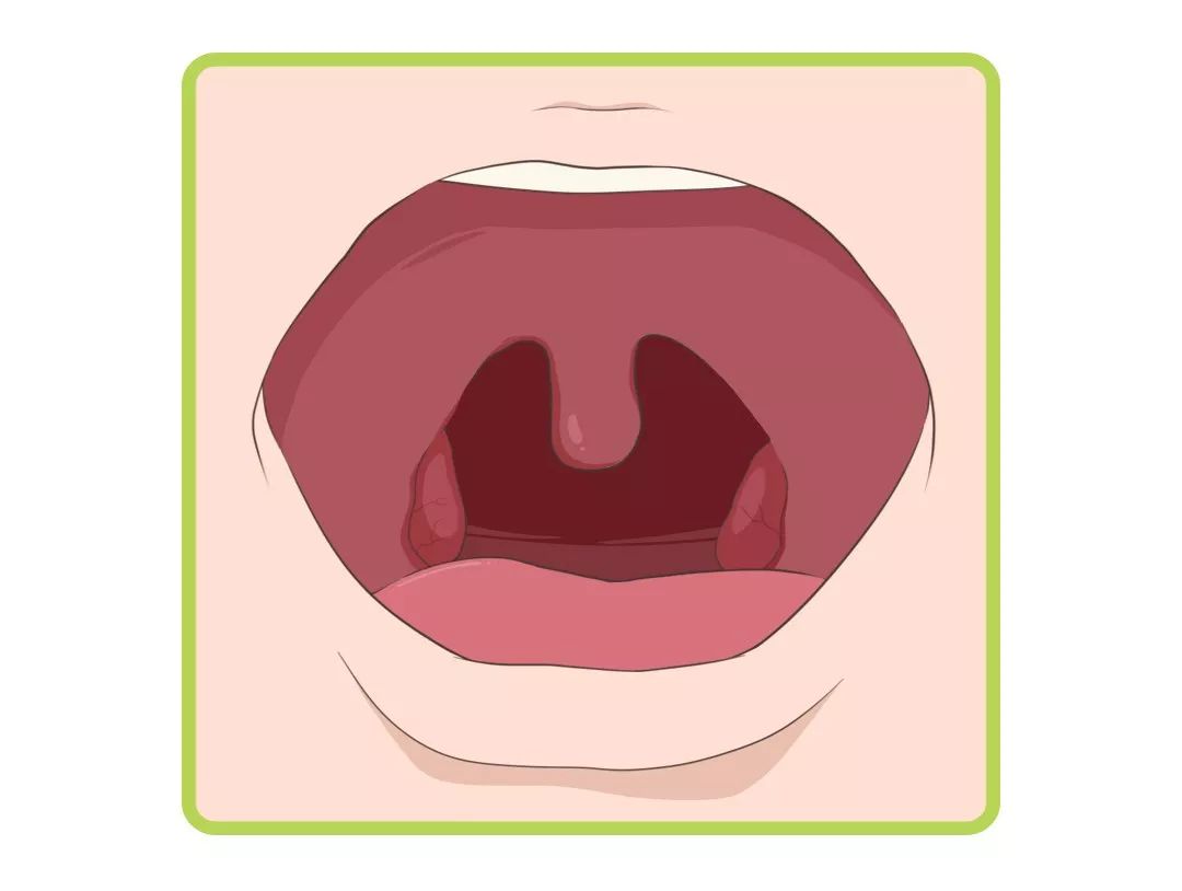 扁桃体超过腭咽弓,属于二度肿大,如图