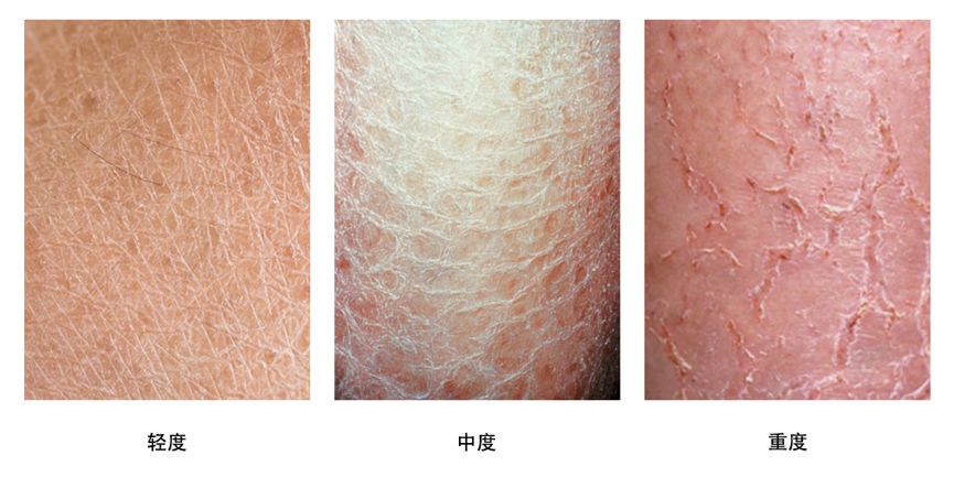 乏脂性湿疹 ,俗称干性湿疹或者皮肤干燥性皮炎.