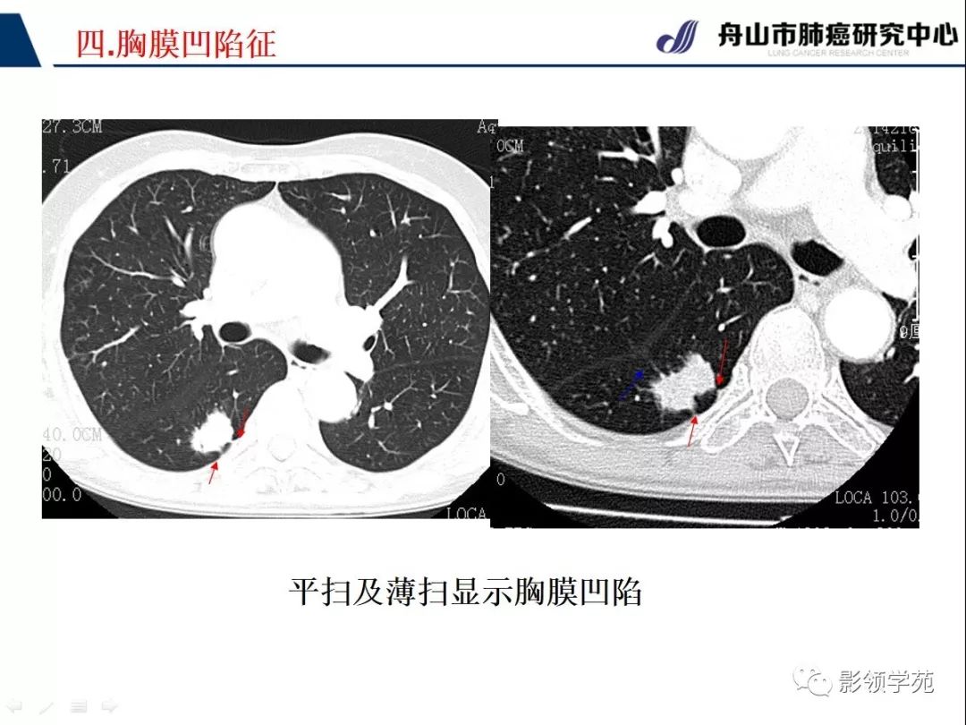 ct征象对早期肺腺癌分型之胸膜凹陷征