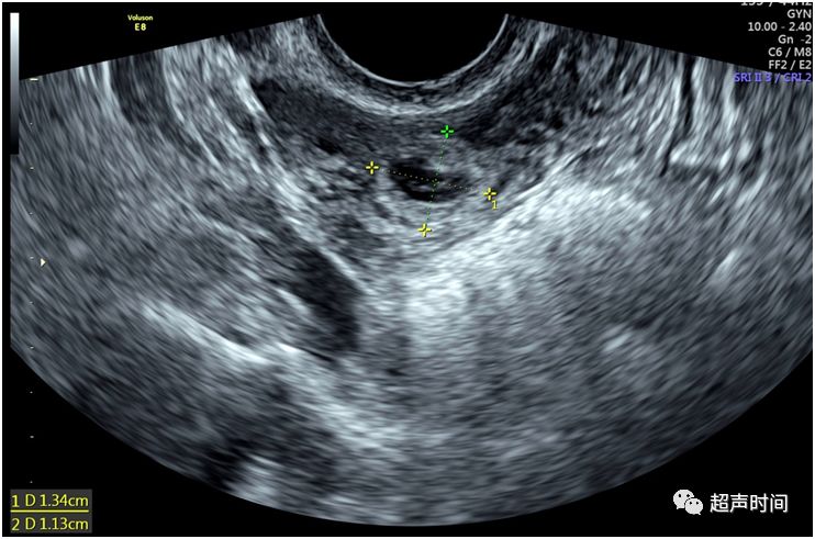 超声典型病例宫内合并宫外妊娠