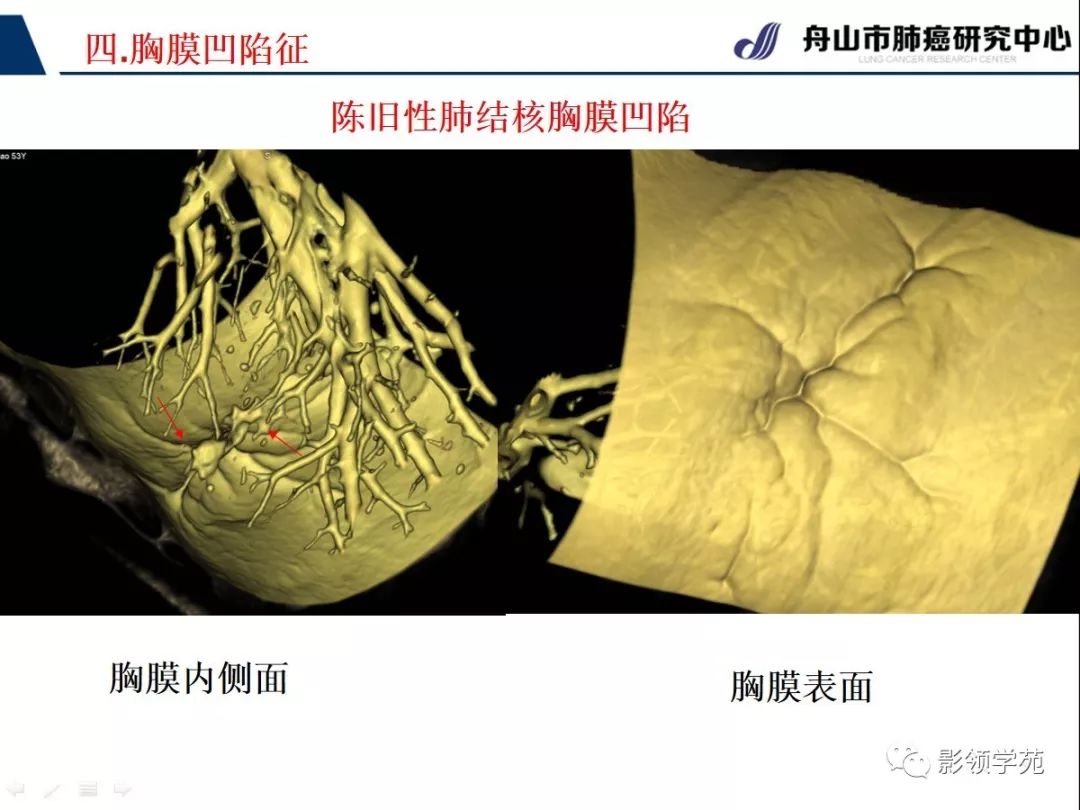 ct征象对早期肺腺癌分型之胸膜凹陷征