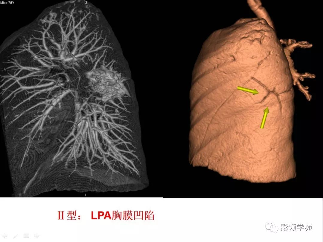 ct征象对早期肺腺癌分型之胸膜凹陷征