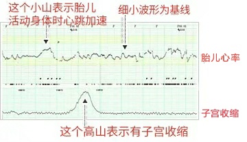 胎心监护报告怎么看结果不理想有2大原因