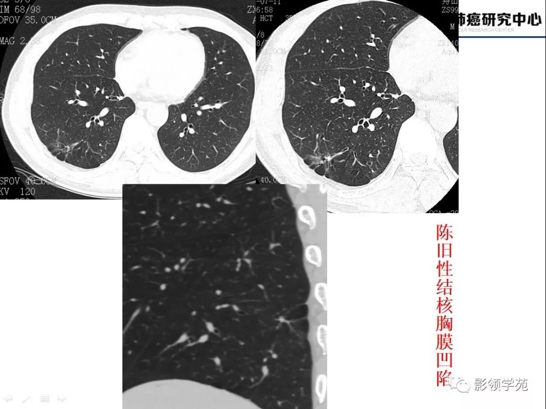 ct征象对早期肺腺癌分型之胸膜凹陷征