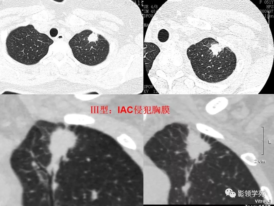 ct征象对早期肺腺癌分型之胸膜凹陷征