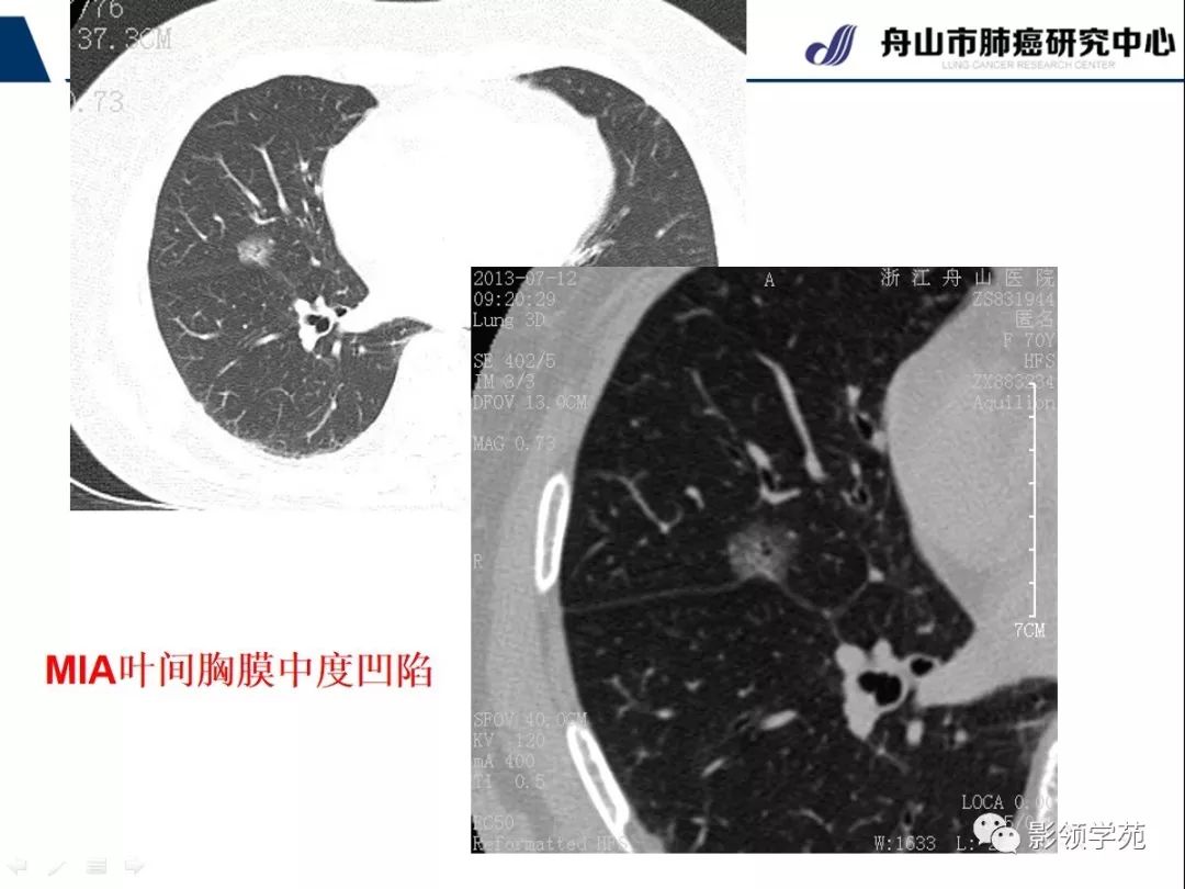 ct征象对早期肺腺癌分型之胸膜凹陷征