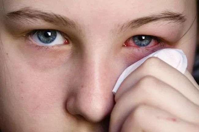 虹膜炎和红眼病有什么区别?