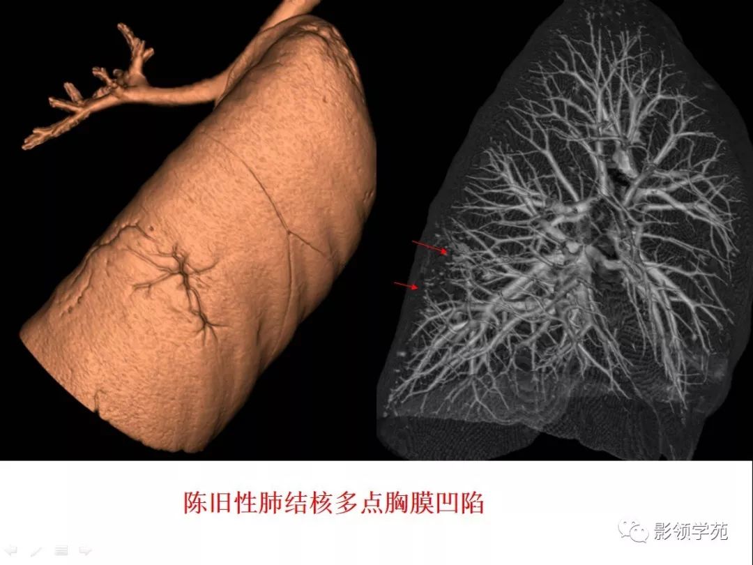 ct征象对早期肺腺癌分型之胸膜凹陷征