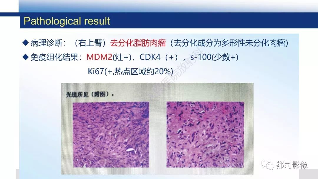 原发性去分化脂肪肉瘤影像诊断