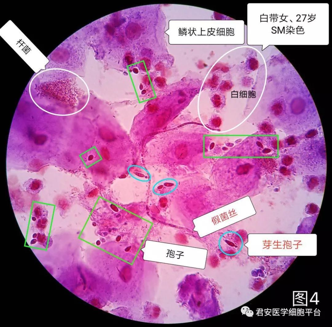 奶油状稀薄白带:阴道加德纳菌感染(细菌性阴道炎).