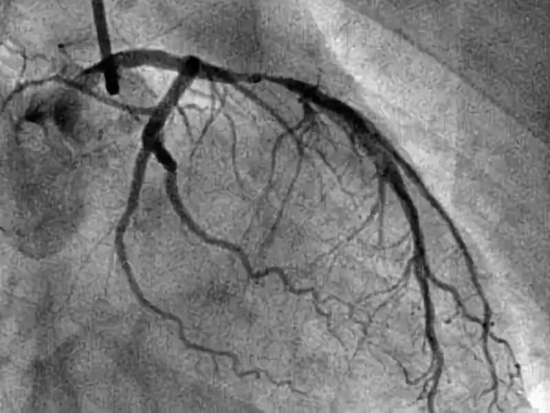 冠脉造影是怎么回事