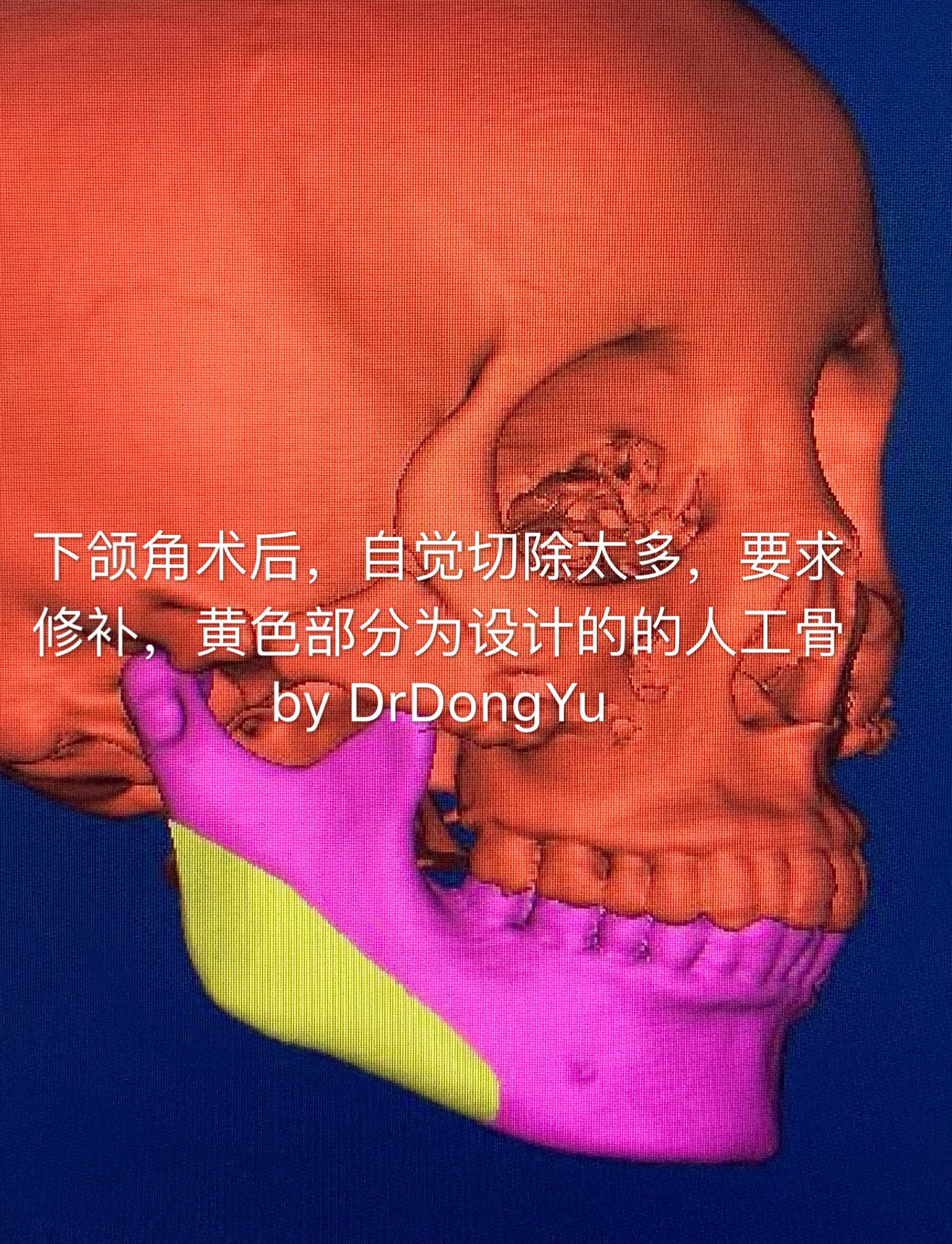 下颌角怎么办