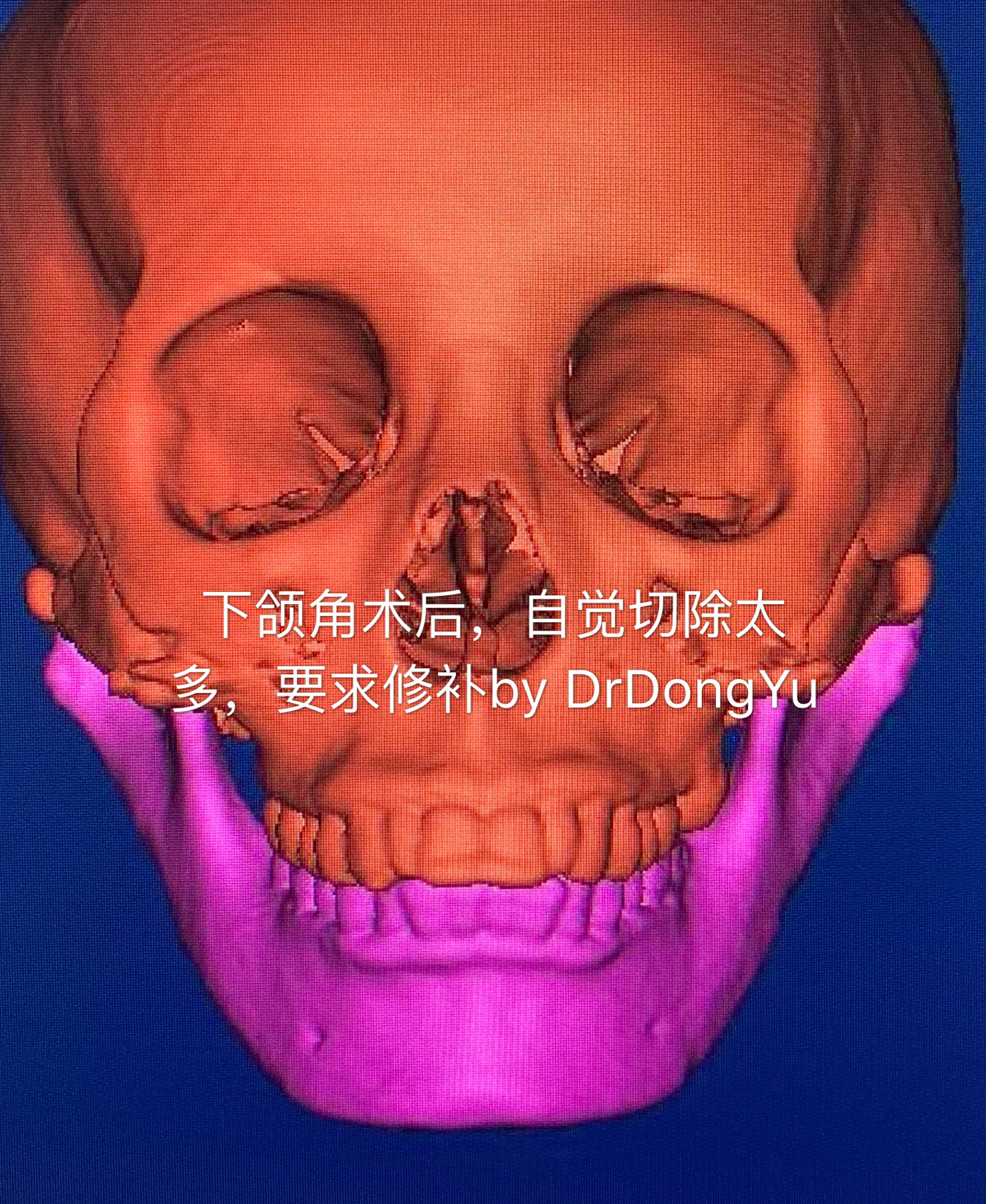 下颌角怎么办