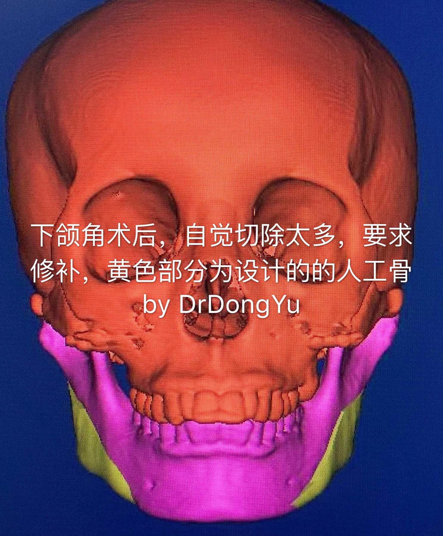 下颌角怎么办