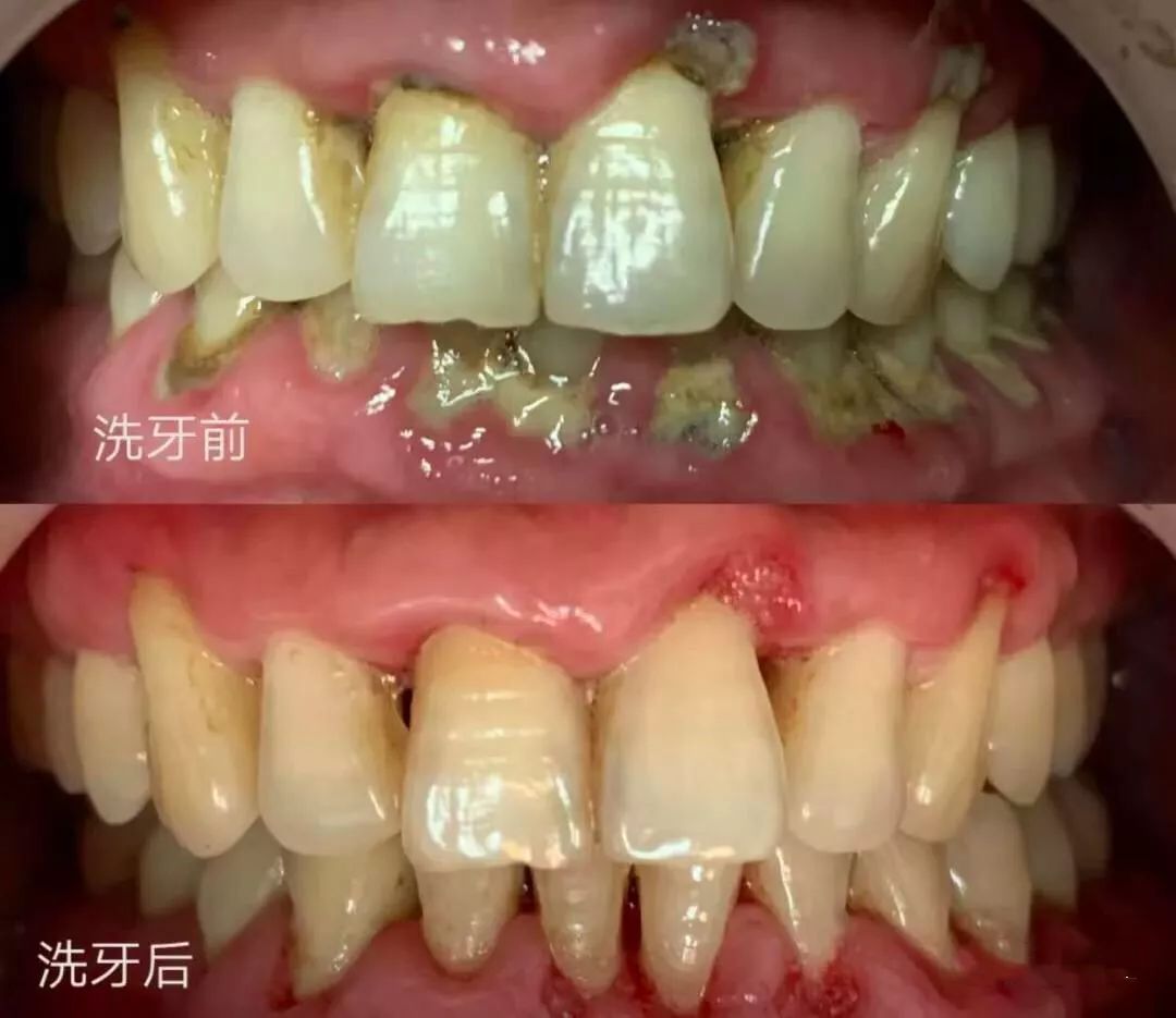 人口中有多少牙齿_奥特曼中有多少种怪兽(3)