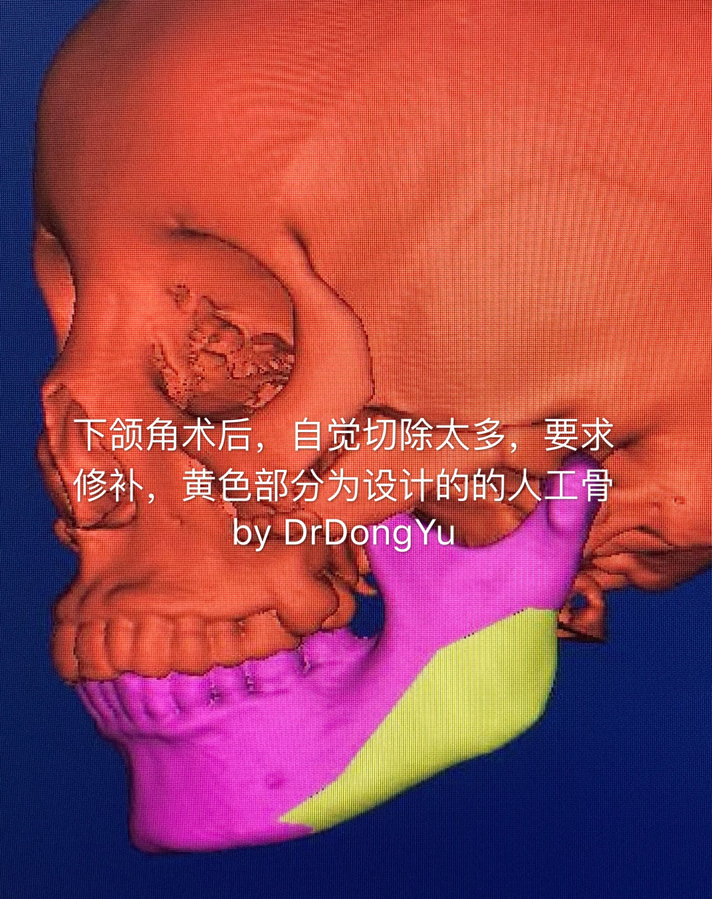 下颌角怎么办