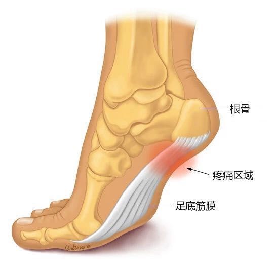 足跟疼痛难忍步行困难你可能患了足底筋膜炎