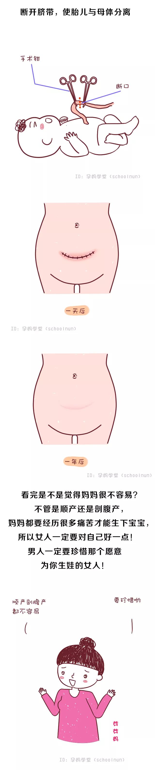 剖腹产要挨几刀缝几层看完心疼女人