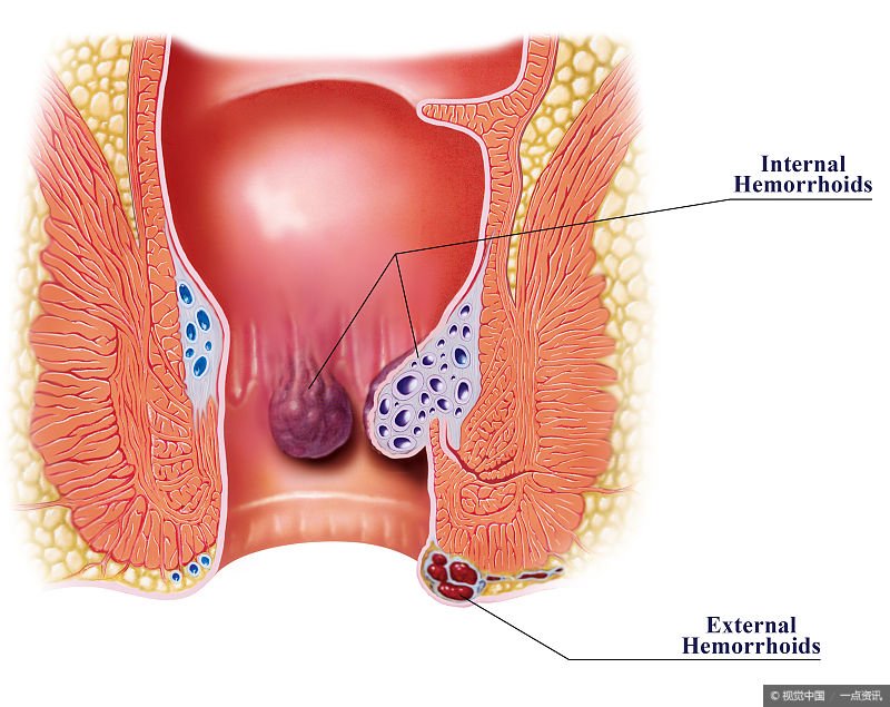 痔疮垫什么原理_轻微的痔疮长什么样子(2)