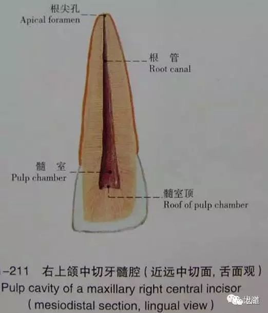 根尖孔以位居根尖者较多(57%);位于根尖旁侧者较少(43%),其中以舌侧