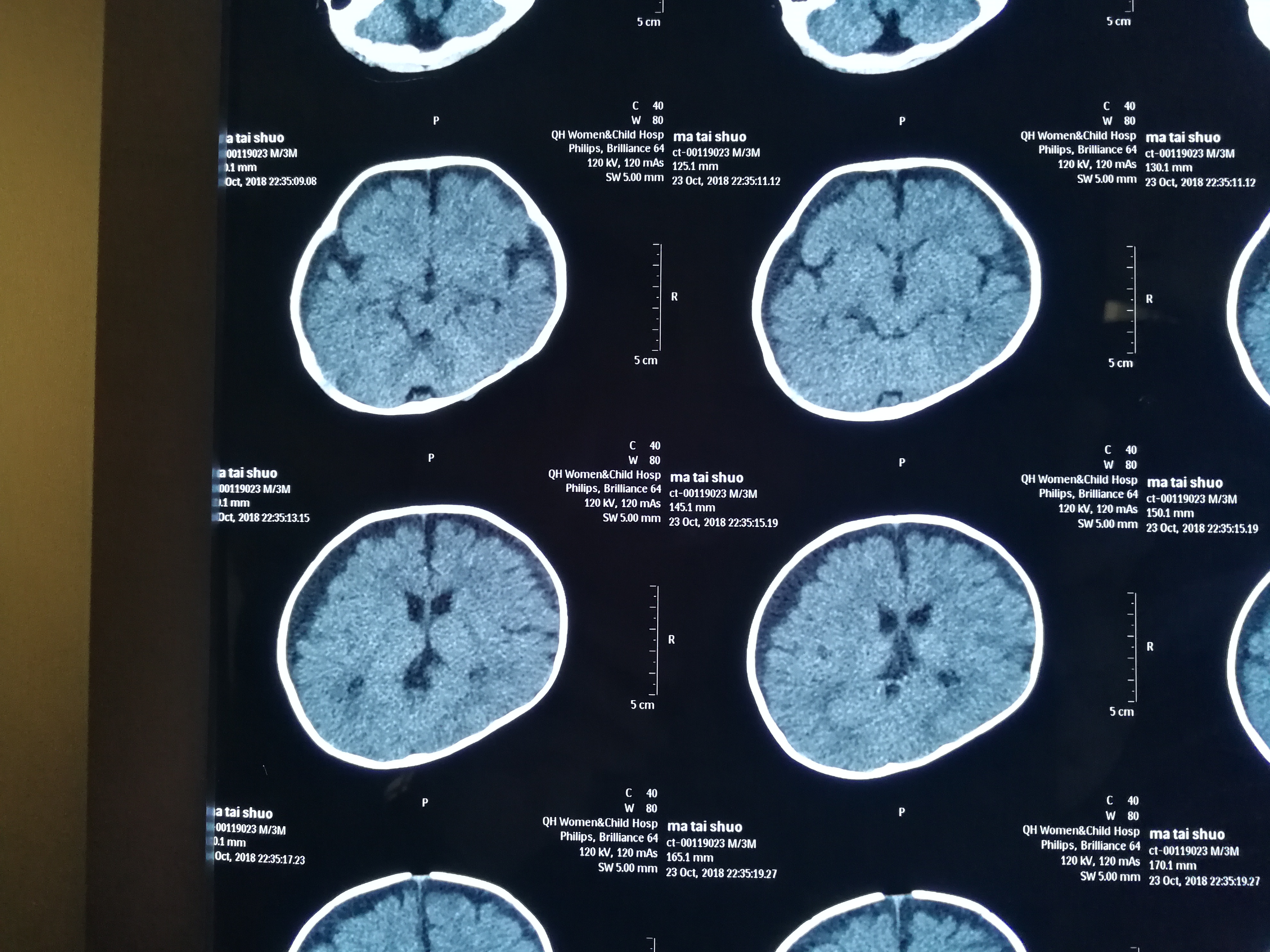 贺晓生教授谈小儿脑病:警惕化脓性脑膜炎后遗硬膜下积液患儿