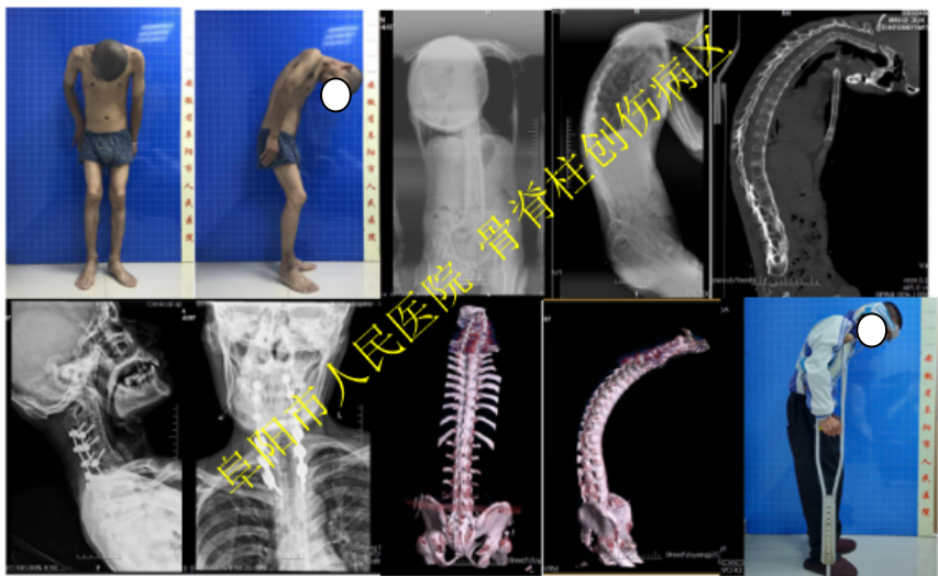 典型病例一:强直性脊柱炎伴脊柱重度后凸畸形("折刀人